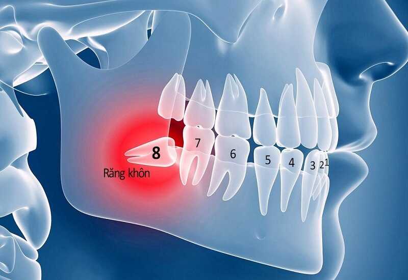 Tình trạng răng mọc ngang nên nhổ trước khi niềng răng