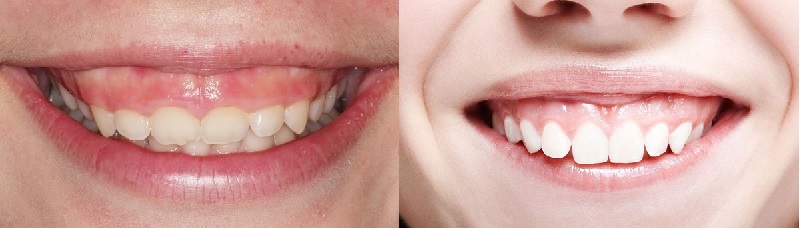 Tình trạng răng hô nướu gây mất thẩm mỹ cho khuôn mặt