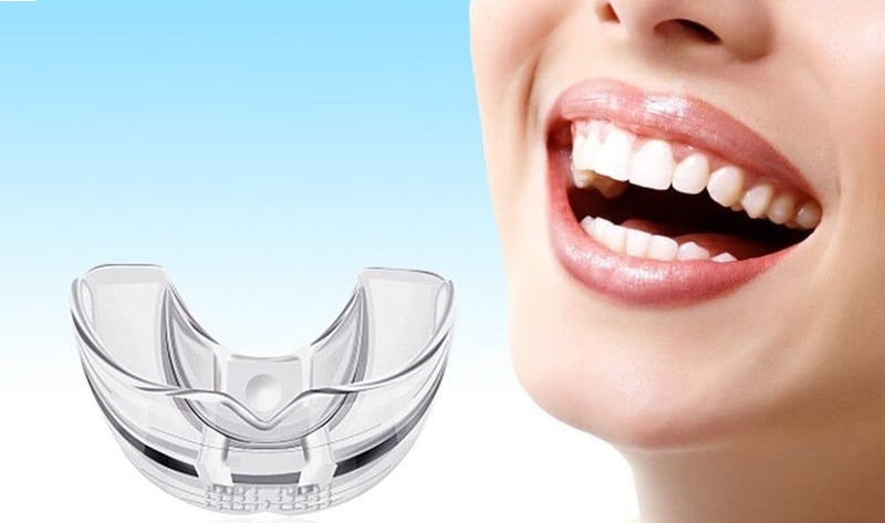 Bộ niềng răng tại nhà giúp hàm răng đều đẹp đơn giản