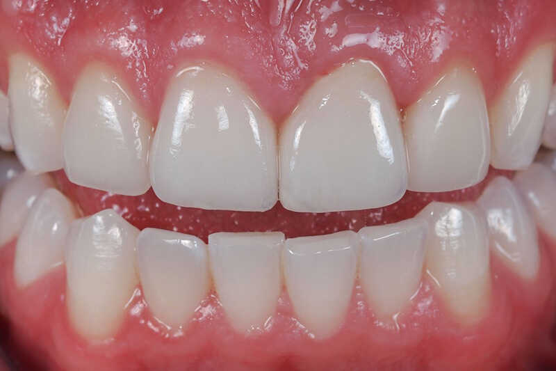 Nướu răng là gì? Nướu răng màu hồng nhạt bao bọc quanh răng