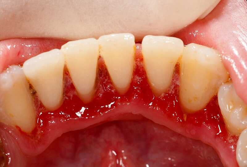 Bệnh về nướu răng rất dễ mắc phải