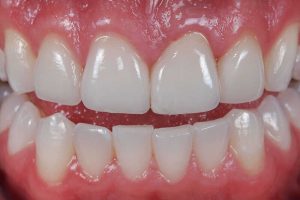 Nướu răng là gì? Giải đáp các thắc mắc liên quan đến nướu răng