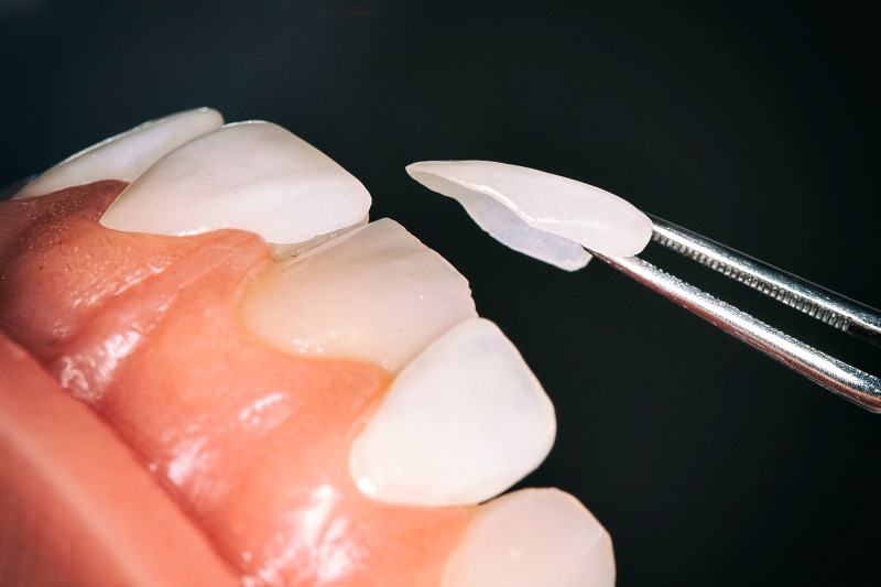 Veneer sứ được xem là lớp vỏ bọc hoàn hảo để mang đến cho bạn một hàm răng trắng đều