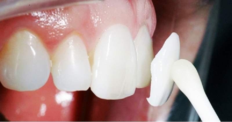 Thời gian răng sứ Veneer bám trên răng bao lâu sẽ phụ thuộc vào nhiều yếu tố