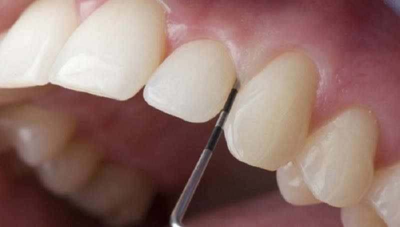 Hạn chế tối đa việc mài răng là ưu điểm của dán sứ Veneer