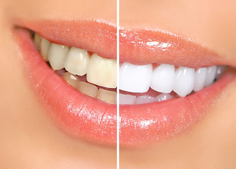 Các phương pháp tẩy trắng răng đều đảm bảo an toàn, hiệu quả