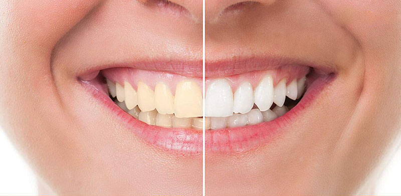 Giá tẩy trắng răng phụ thuộc vào cơ sở nha khoa 