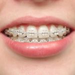 Niềng răng hô nhẹ giúp cân đối khớp cắn, đảm bảo tính thẩm mỹ
