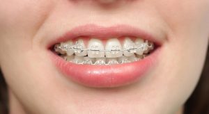Niềng răng hô nhẹ giúp cân đối khớp cắn, đảm bảo tính thẩm mỹ