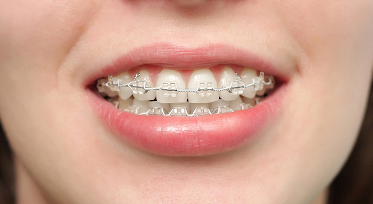 Niềng răng giúp cân đối khớp cắn, đảm bảo tính thẩm mỹ