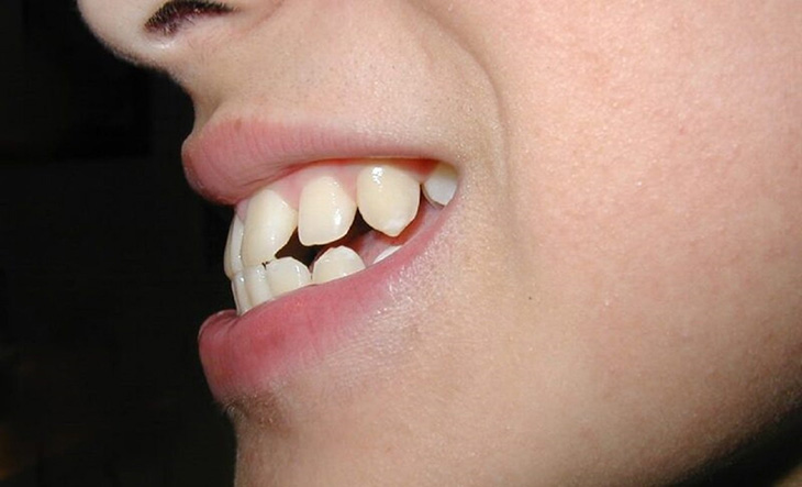 Răng hô nhẹ hay răng vẩu nhẹ là tình trạng sai lệch về khớp cắn