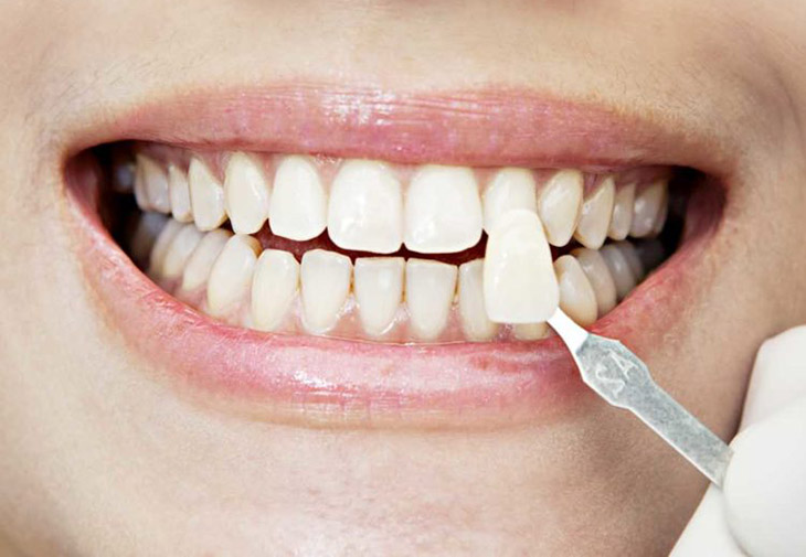 Bọc răng sứ giúp cải thiện tình trạng hô nhẹ một cách nhanh chóng