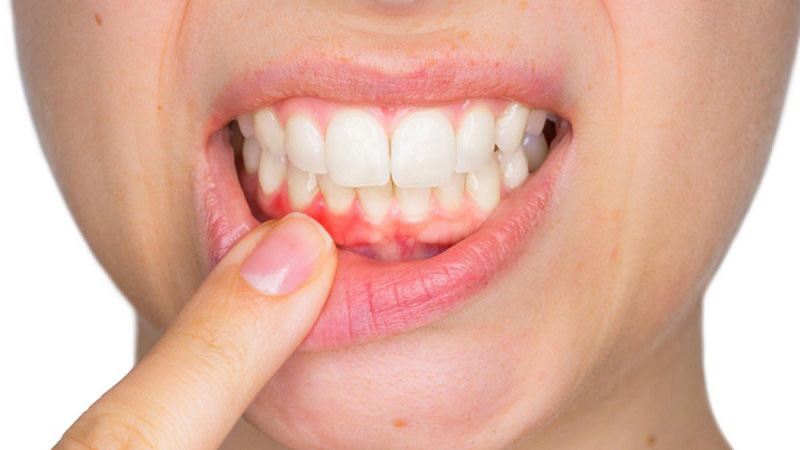 Mọc răng số 8 có thể gây nên một số bệnh về nướu