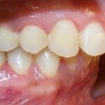 Răng hô nặng là dạng sai khớp cắn mà hàm trên nhô ra ngoài