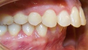 Răng hô nặng là dạng sai khớp cắn mà hàm trên nhô ra ngoài