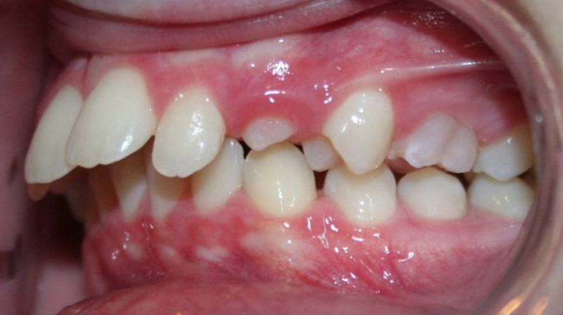 Hàm mặt sai lệch trong quá trình phát triển cũng dẫn tới hô răng