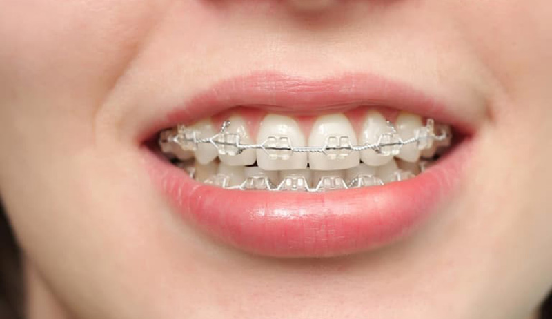 Niềng răng là phương pháp chữa vẩu hiệu quả
