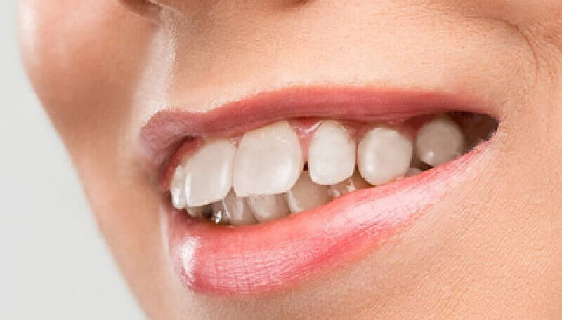 Bọc răng sứ chỉ phù hợp với những trường hợp hô không quá nghiêm trọng