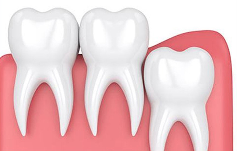Thông thường răng khôn sẽ mọc vào năm 18 - 25 tuổi