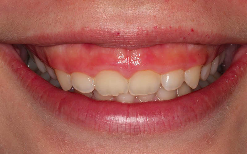 Thân răng ngắn gây cười hở lợi là nguyên nhân phổ biến