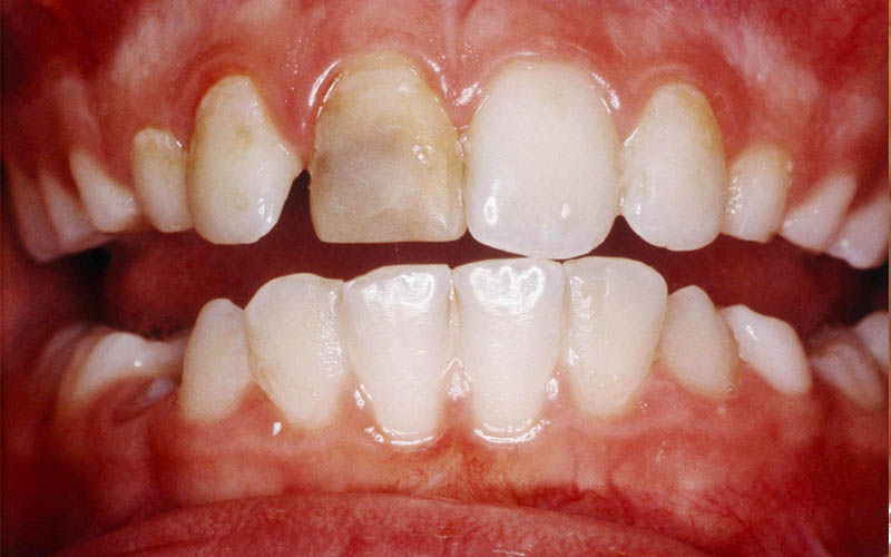 Thiểu sản men răng có thể dẫn tới suy giảm chức năng ăn nhai