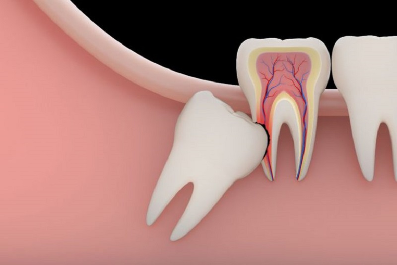 Răng khôn mọc ngầm là răng mọc ở dưới nướu hoặc chỉ có một phần trồi lên