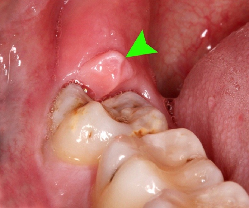 Vi khuẩn tích tụ trong mảng bám và cao răng là nguyên nhân hàng đầu gây sâu răng khôn