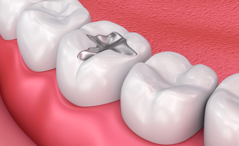 Composite là chất liệu trám răng được lựa chọn phổ biến hàng đầu hiện nay
