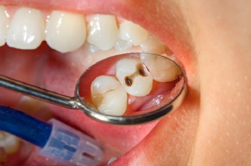 Các bước trám răng được thực hiện khá nhanh chóng