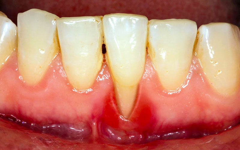 Tụt lợi chân răng hàm dưới thường khó phát hiện hơn so với hàm trên