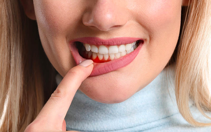 Bệnh nha chu là một trong những nguyên nhân gây tụt lợi chân răng