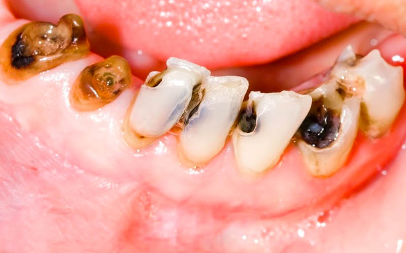 Tình trạng tụt lợi chân răng làm gia tăng nguy cơ sâu răng