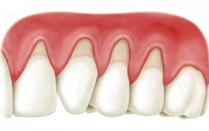 Tụt lợi chân răng là gì