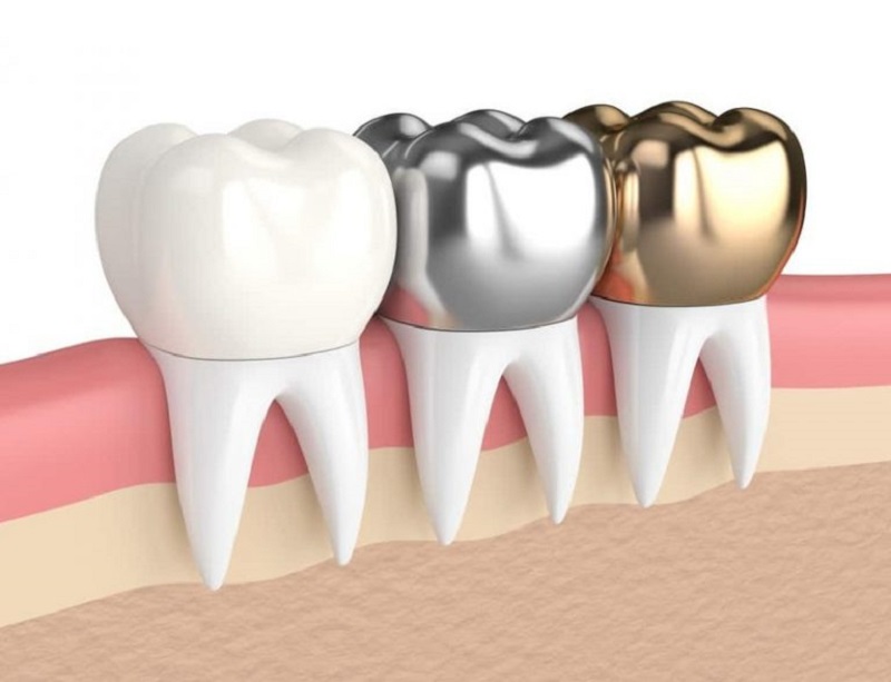 Mão răng được làm bằng bạc có độ bền cực cao