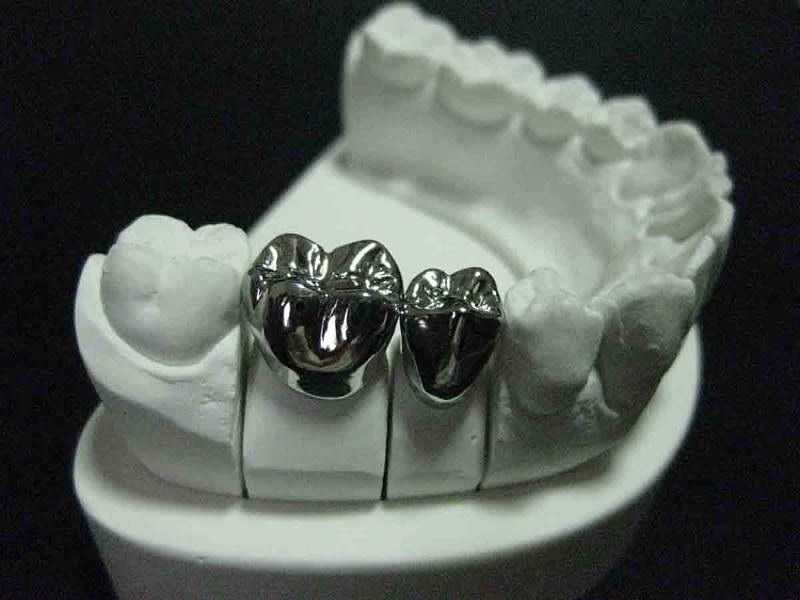 Chi phí bọc răng bằng bạc có liên quan nhiều đến số lượng răng cần bọc
