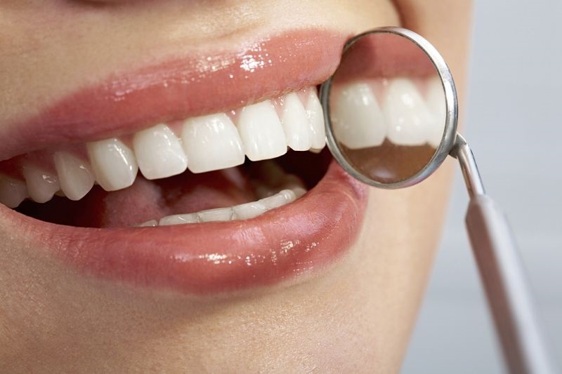 Bọc răng composite giúp khắc phục tình trạng răng sứt mẻ nhẹ, mòn men răng, răng thưa nhẹ,...