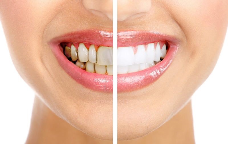 Bọc răng nhựa có tốt không sẽ tùy thuộc vào từng trường hợp bệnh nhân cụ thể