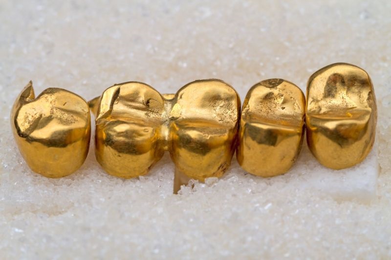 Răng bọc vàng có độ bền cao và cực kỳ lành tính
