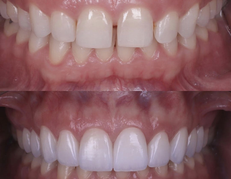 Phương pháp này mang đến vẻ đẹp cho hàm răng một cách an toàn và nhanh chóng