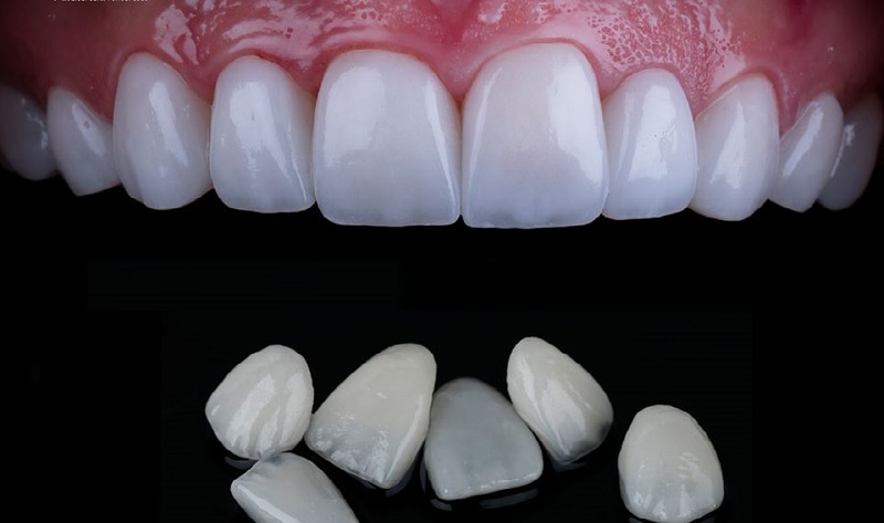 Giá răng sứ veneer phụ thuộc nhiều vào chất liệu áp dụng
