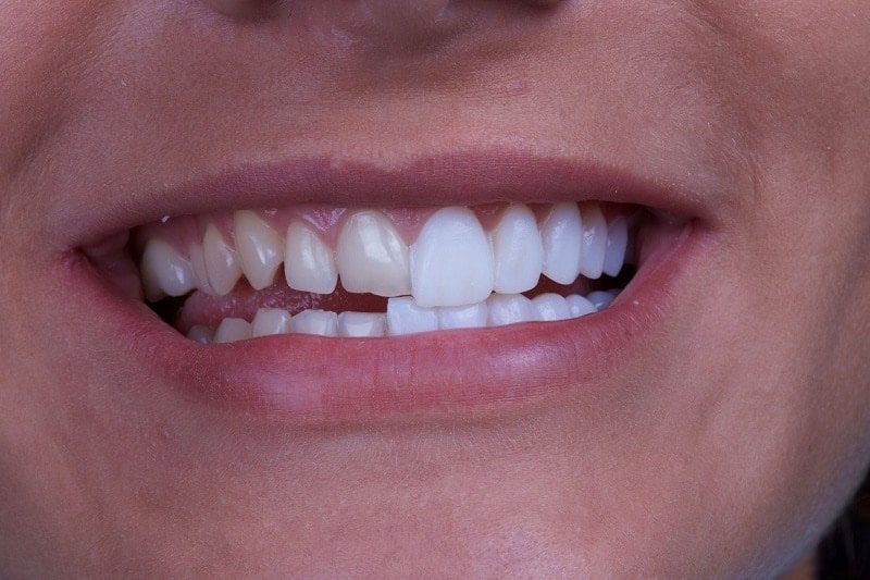 Dán răng sứ veneer đem lại hiệu quả thẩm mỹ cao và giúp bảo tồn tốn đa răng thật