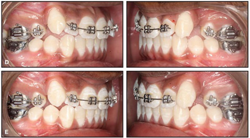 Để niềng răng giữ lại răng khểnh thì mắc cài sẽ không được gắn vào chiếc răng khểnh