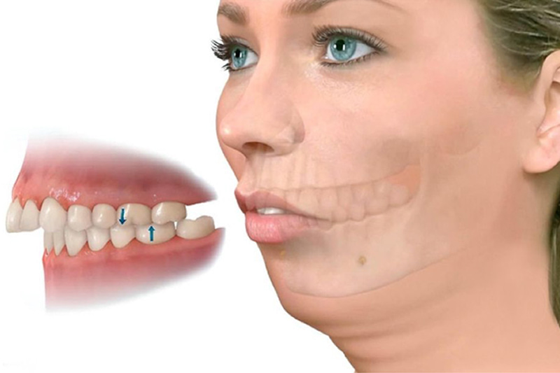 Biểu hiện răng hô hàm trên
