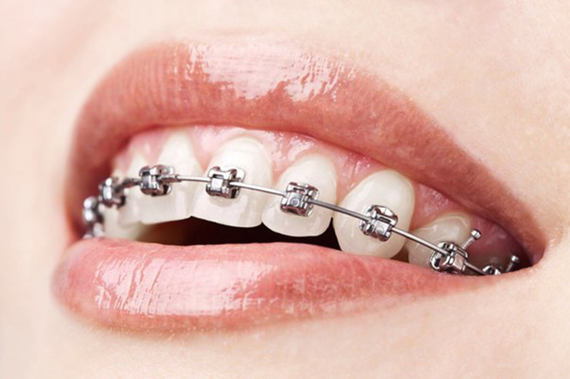 Thời gian niềng răng phụ thuộc vào tình trạng răng miệng