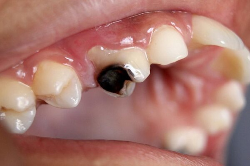 Răng số 3 bị sâu vỡ cần được loại bỏ khi niềng răng