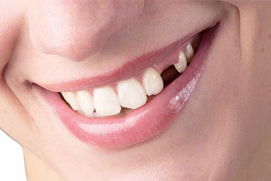 Mất răng số 3 không ảnh hưởng đến việc niềng răng