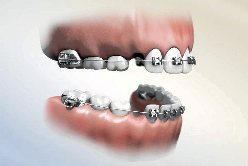 Để quá trình niềng răng diễn ra thuận lợi, có một số trường hợp nha sĩ yêu cầu bạn phải nhổ răng