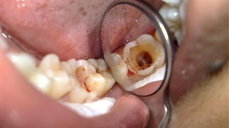 Răng số 5 bị sâu phải nhổ bỏ trước khi niềng răng