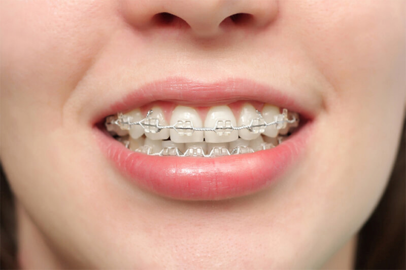 Người bị mất răng số 5 vẫn có niềng răng như bình thường