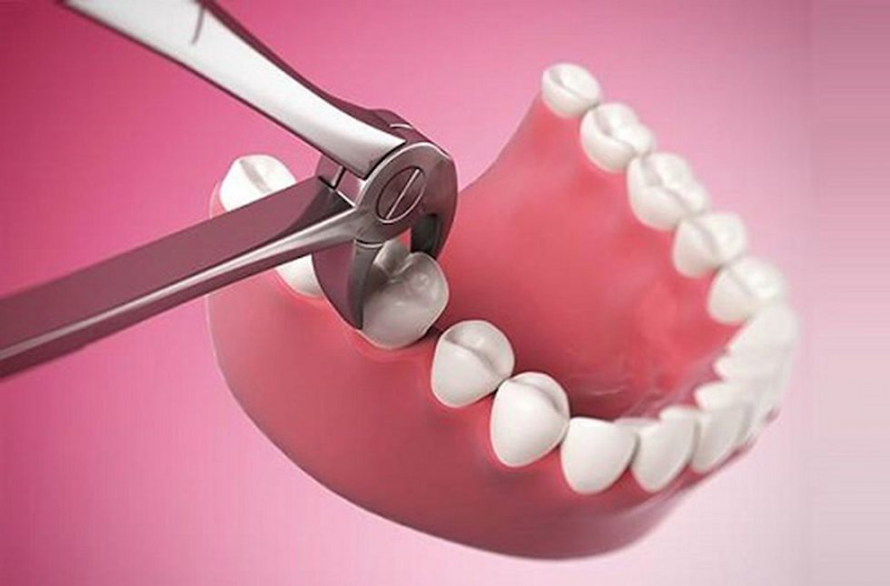 Răng số 6 bị nhổ bỏ khi niềng răng nếu đã bị sâu, mọc lệch,...nghiêm trọng
